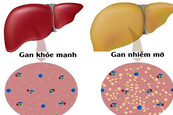 Gan nhiễm mỡ là tình trạng ứ đọng mỡ trong gan